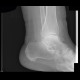 Fracture of tibial malleolus: X-ray - Plain radiograph
